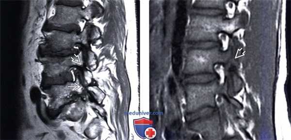 МРТ спондилолиза