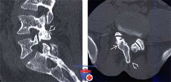 Рентгенограмма, КТ спондилолиза