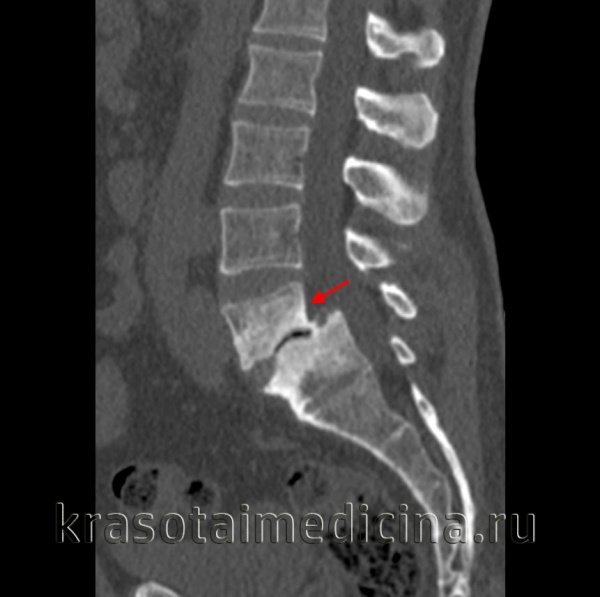 Спондилолистез