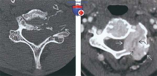 Рентгенограмма, КТ, МРТ при литических и бластических метастазах в шейные позвонки