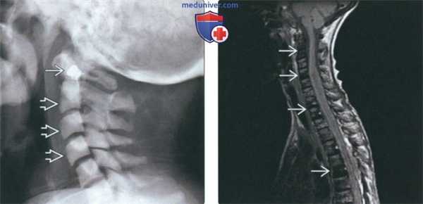 Рентгенограмма, КТ, МРТ при литических и бластических метастазах в шейные позвонки