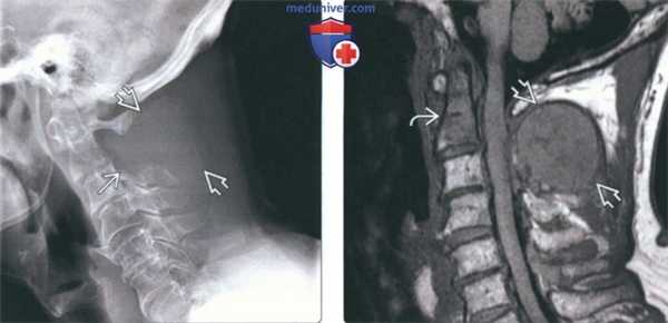 Рентгенограмма, КТ, МРТ при литических и бластических метастазах в шейные позвонки