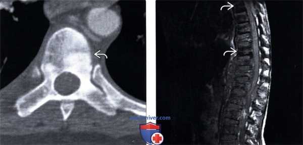 КТ, МРТ бластических костных метастазов позвоночника