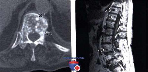 КТ, МРТ бластических костных метастазов позвоночника