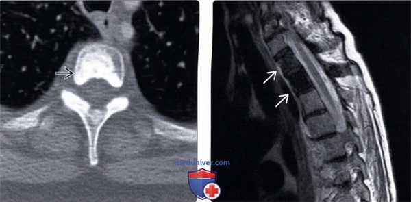 КТ, МРТ бластических костных метастазов позвоночника