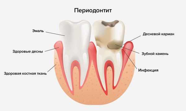 Периодонтит