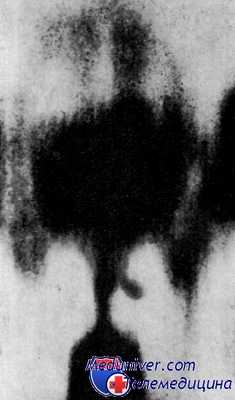 томография гортани