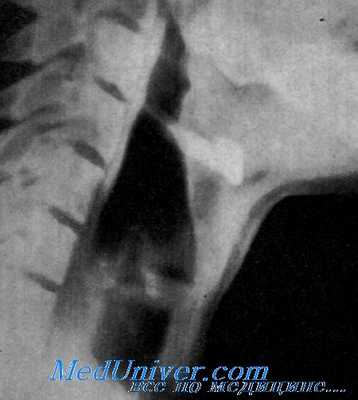 рентгенография гортани