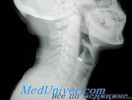 рентгенокимография глотки и голосовых связок