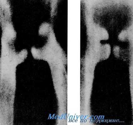 томография гортани