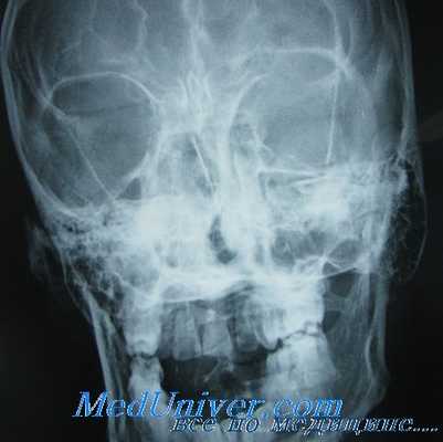 огнестрельные ранения глаза