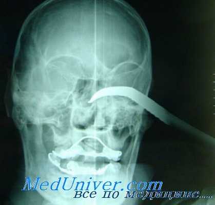 травма глазницы