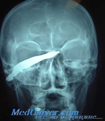 огнестрельные травмы глаза