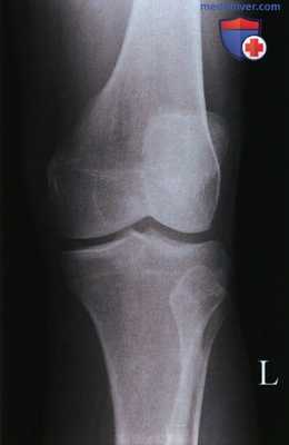 Укладка при рентгенограмме коленного сустава в ПЗ проекции