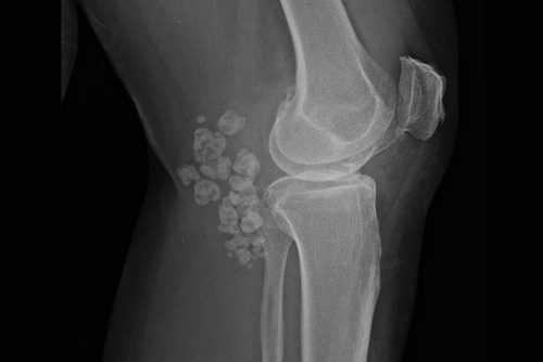 Хондроматоз колена на рентгене