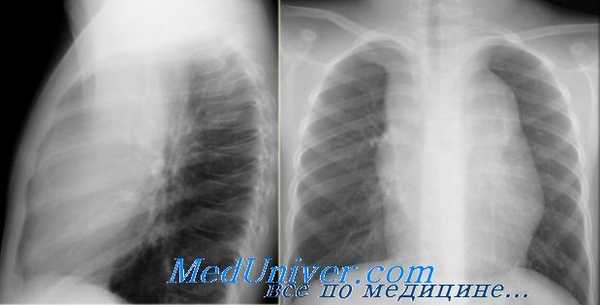 рентгенография в гематологии