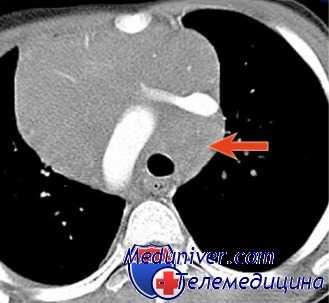 КТ органов грудной клетки при лимфоме