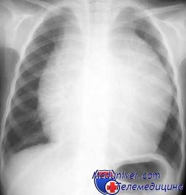 рентгенограмма при лимфоме