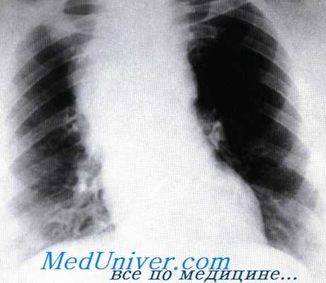 рентгенограмма при лимфоме