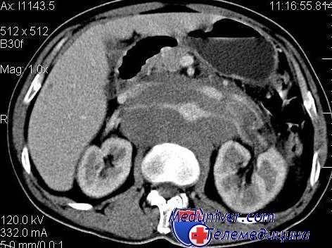 КТ органов брюшной полости при лимфоме