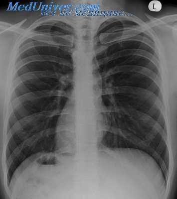 праворасположенное сердце