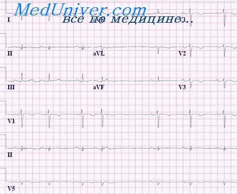 праворасположенное сердце