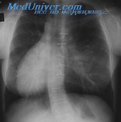 аномалии положения сердца