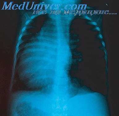 аномалии положения сердца