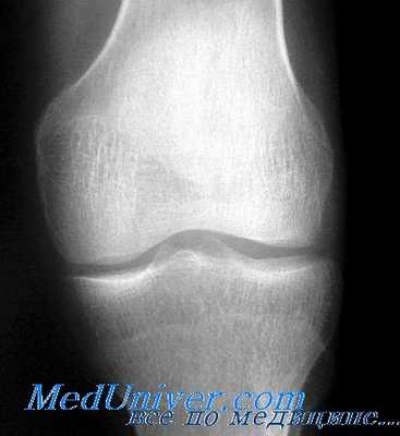 рентгенография костей