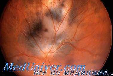 рентгенотерапия воспалений глаза