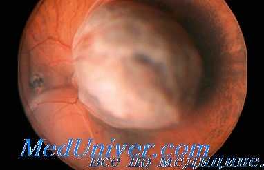 облучение рентгеновскими лучами