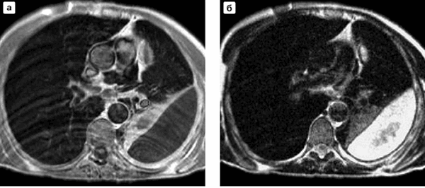 Эмпиема плевры на МРТ