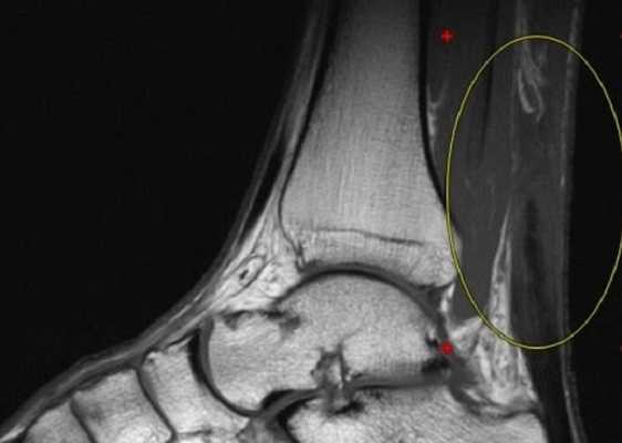 МРТ голеностопного сустава в сагиттальной плоскости