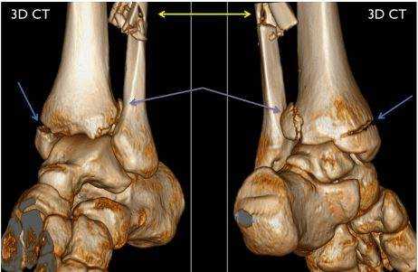 3D-модель голеностопа (вид спереди и сзади). Стрелками указаны места переломов