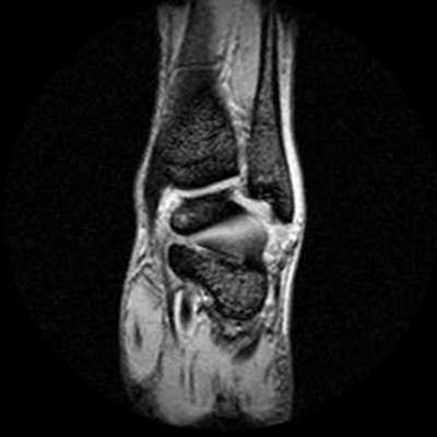 МРТ голеностопного сустава, как проходит