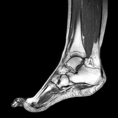 КТ голеностопного сустава