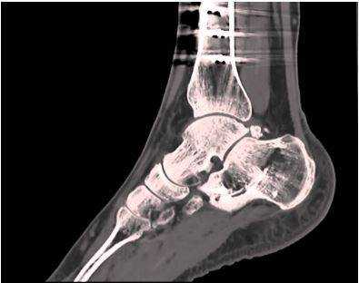 Томограмма голеностопного сустава
