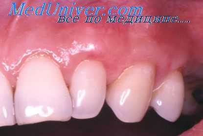 исследование пародонта