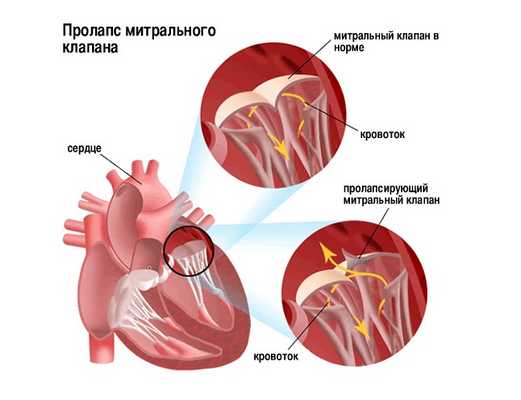 Пролапс митрального клапана