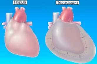 Перикардит