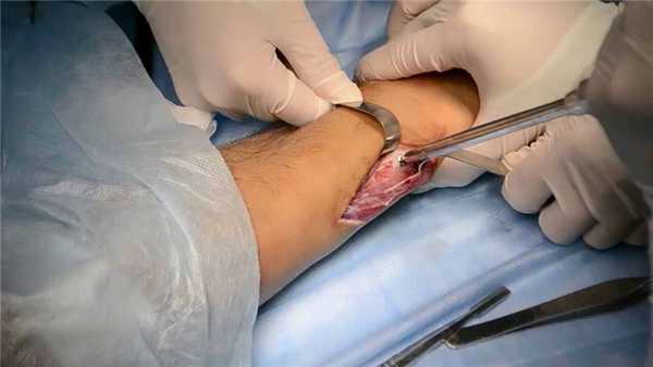 хирургическое удаление фиксирующей пластины