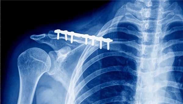 фиксатор при переломе ключицы