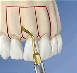 Ускорение ортодонтического лечения воздействием на пародонт