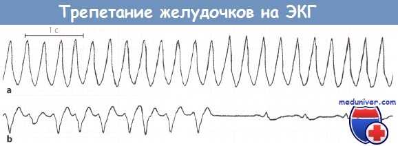 Трепетание желудочков на ЭКГ