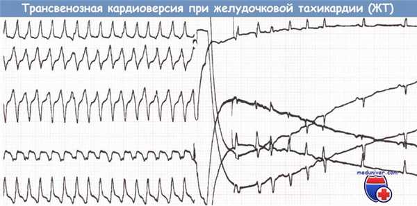 Трансвенозная кардиоверсия при желудочковой тахикардии (ЖТ)