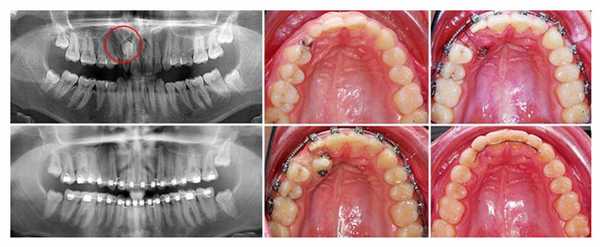 Этапы лечения ретинированного зуба