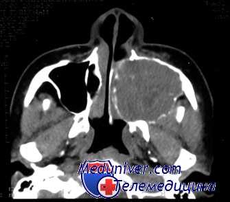 дермоидные кисты век глаза