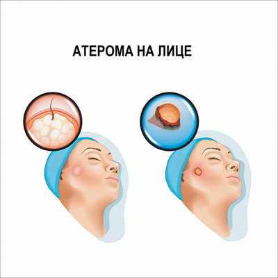 Атерома на лице.jpg