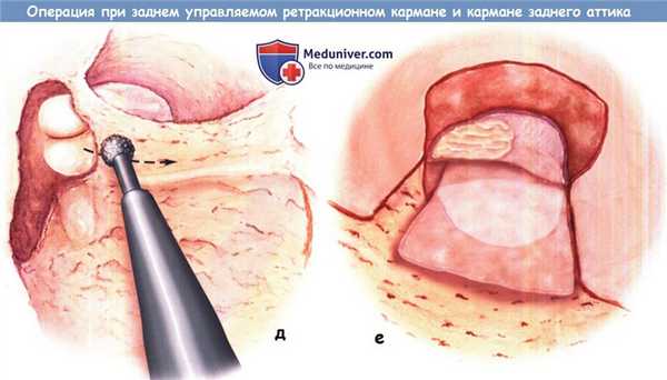Лечение заднего управляемого ретракционного кармана и кармана заднего аттика
