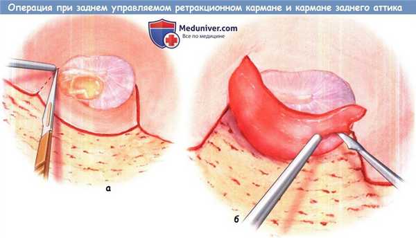 Лечение заднего управляемого ретракционного кармана и кармана заднего аттика
